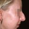 Rhinoplasty (Nose Job)