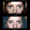 Blépharoplastie