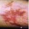 Laser Scar Treatment