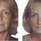 Facelift