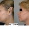 Chirurgie du double-menton
