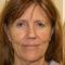 Facelift, SMAS facelifting