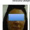 Lipofilling (grasso)