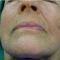 PRP – Plazma terapia (Drakula terapia)