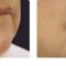 Fotorejuvenizácia /Resurfacing