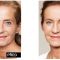 Skinbooster – Vital Injector
