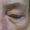 Operácia očných viečok (Blepharoplastika)