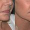 Lifting du visage