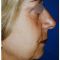 Lifting du visage