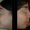 Rhinoplastie médicale
