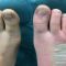 Aesthetic foot and ankle surgery