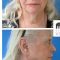 Lifting du visage
