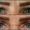 Operácia obočia (Brow lift)