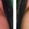 Implantes faciales