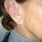 Otoplastie (Chirurgie esthétique des oreilles)