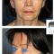 Lipofilling du visage