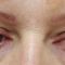 Laserová blefaroplastika