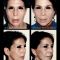 Lifting du visage
