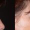 Forehead lift (Brow lift)