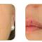 PRP – Plazma terapia (Drakula terapia)