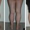 Lipofilling (grasso)