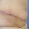 Abdominoplastika (Operácia brucha)