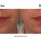 Hyaluronic acid-based wrinkle fillers