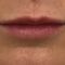 Lippenvergrößerung mit Hyaluronsäure