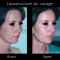 Lipofilling ou autogreffe de tissu graisseux