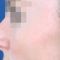 Operácia nosa (Rhinoplastika)