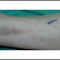 Varices