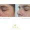 Operácia očných viečok (Blepharoplastika)