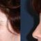 Forehead lift (Brow lift)
