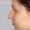 Plastika nosu (Rhinoplastika)