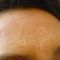 Mikrojehličkování, Microneedling (Skinroller - Dermaroller)