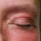 Operácia očných viečok (Blepharoplastika)