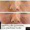 Lipofilling ou autogreffe de tissu graisseux