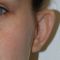 Otoplastie (Chirurgie esthétique des oreilles)