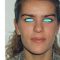 Operazione orecchie (Otoplastica)