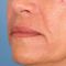 Injections d