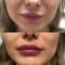 Kwas hialuronowy: Saypha, Restylane, Juvederm, Stylage
