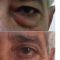 Blépharoplastie inférieure