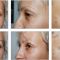 Operácia očných viečok (Blepharoplastika)