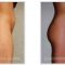 Liposuction