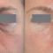 Blépharoplastie inférieure