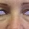 Eyelid surgery (Blepharoplasty)