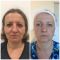 Kwas hialuronowy: Saypha, Restylane, Juvederm, Stylage