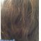 Trapianto capelli