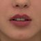 Lip Lift