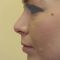 Rhinoplasty (Nose Job)